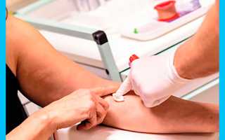 Идеальное соотношение ЛГ и ФСГ: норма в таблице