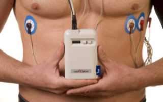 Тахиаритмия лечение, симптомы, диагностика, виды