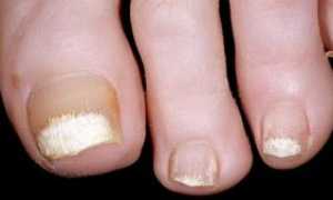 Как выглядит грибок на ногтях рук и как правильно его лечить