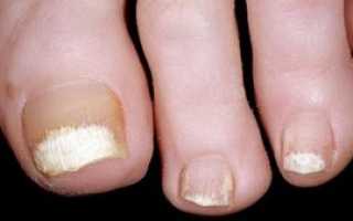 Как выглядит грибок на ногтях рук и как правильно его лечить
