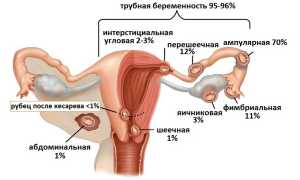 Внематочная беременность: почему возникает и как лечится