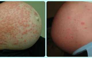 Как лечить герпес при беременности?