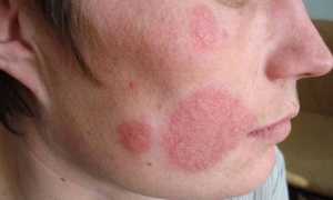 Поражение кандидозом кожного покрова лица