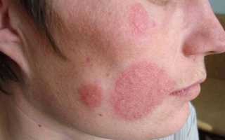Поражение кандидозом кожного покрова лица