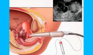Донорство яйцеклеток: описание процедуры и стоимость