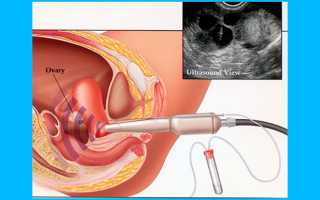 Донорство яйцеклеток: описание процедуры и стоимость