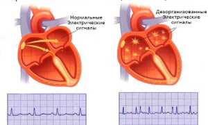 Как лечить мерцательную аритмию сердца в домашних условиях