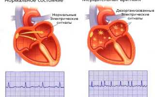 Как лечить мерцательную аритмию сердца в домашних условиях