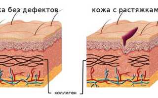 Растяжки при беременности