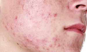 Золотистый стафилококк — инкубационный период, симптомы и лечения