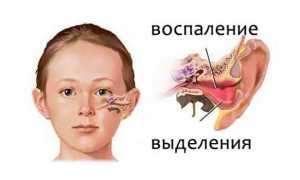 Аллергический отит у детей и взрослых — симптомы и лечение