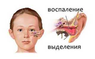 Аллергический отит у детей и взрослых — симптомы и лечение