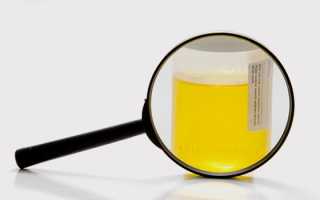 Анализ мочи по Сулковичу