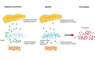 Моча пахнет ацетоном — что это и причины