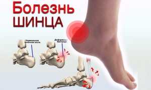 Болезнь Шинца — пяточной кости у детей и взрослых