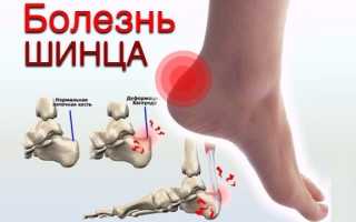 Болезнь Шинца — пяточной кости у детей и взрослых