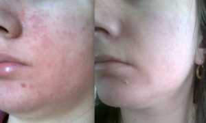 Причины появления грибка на лице и способы лечения