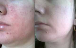 Причины появления грибка на лице и способы лечения