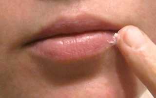 Цинковая мазь – инструкция по применению