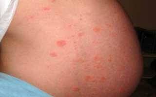 Почему появляется аллергия при беременности, и как ее лечить?