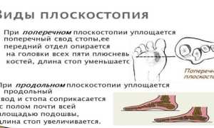 Симптомы плоскостопия 3 степени у ребенка и взрослого — характерные признаки и проявления