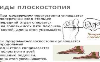 Симптомы плоскостопия 3 степени у ребенка и взрослого — характерные признаки и проявления