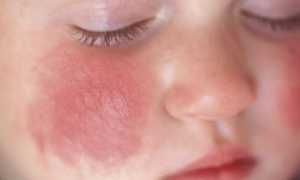 Аллергический дерматит у детей — причины, диагностика и лечение