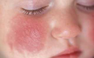 Аллергический дерматит у детей — причины, диагностика и лечение