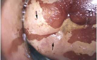 Йоднегативная зона: признак патологии на шейке матки