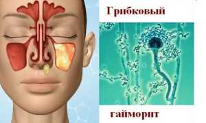 Виды гайморита у взрослых и детей — симптомы и лечение