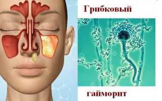 Виды гайморита у взрослых и детей — симптомы и лечение