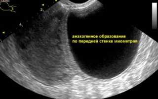 Анэхогенное образование в матке: понятие, диагностика и лечение