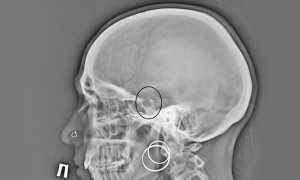 Диагностика аденомы гипофиза — симптомы и признаки заболевания у мужчин и женщин