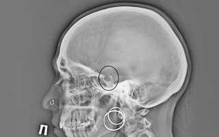 Диагностика аденомы гипофиза — симптомы и признаки заболевания у мужчин и женщин