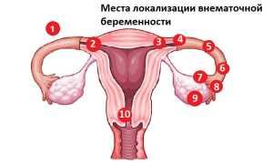 Признаки внематочной беременности
