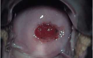 Деформация шейки матки: опасно или нет?