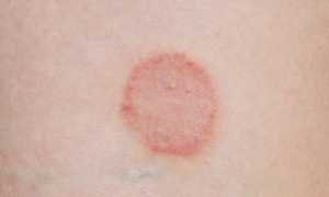 Красный плоский лишай