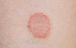 Красный плоский лишай