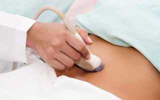 Фибромиома матки — причины и симптомы заболевания, диагностика, методы лечения и профилактика