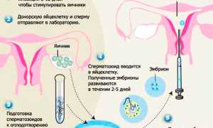 Как берут яйцеклетку у женщины: подготовка и пункция