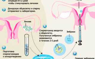 Как берут яйцеклетку у женщины: подготовка и пункция