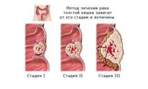 Аденокарцинома прямой кишки — виды опухоли, диагностика, стадии и методы лечения