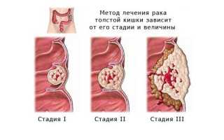 Аденокарцинома прямой кишки — виды опухоли, диагностика, стадии и методы лечения