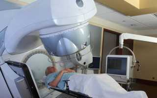 Лучевая терапия