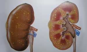 Последствия цистита у женщин — причины возникновения осложнений