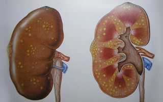 Последствия цистита у женщин — причины возникновения осложнений