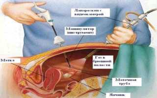 Методы диагностики внематочной беременности