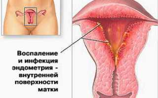 Эндомиометрит: симптомы, диагностика и способы лечения