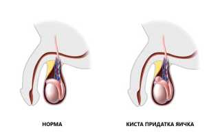 Третье яичко в урологии