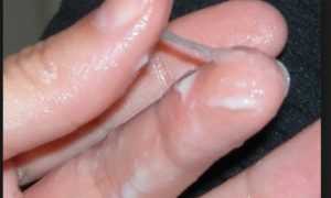 Виды и причины неприятных выделений при молочнице